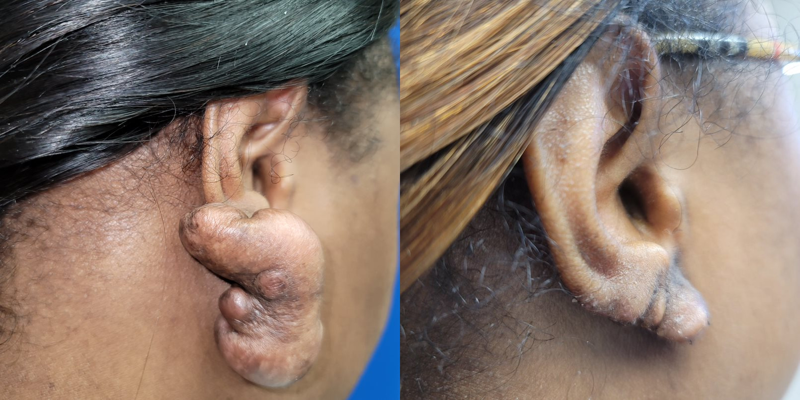 Keloids Before and After Photo by Dr. Williams in Memphis Tennessee