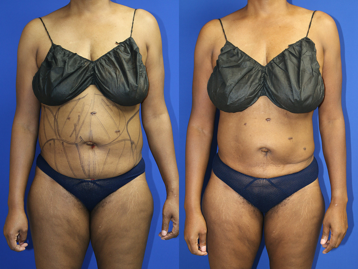 Liposuction 360 Before and After Photo by Dr. Williams in Memphis Tennessee