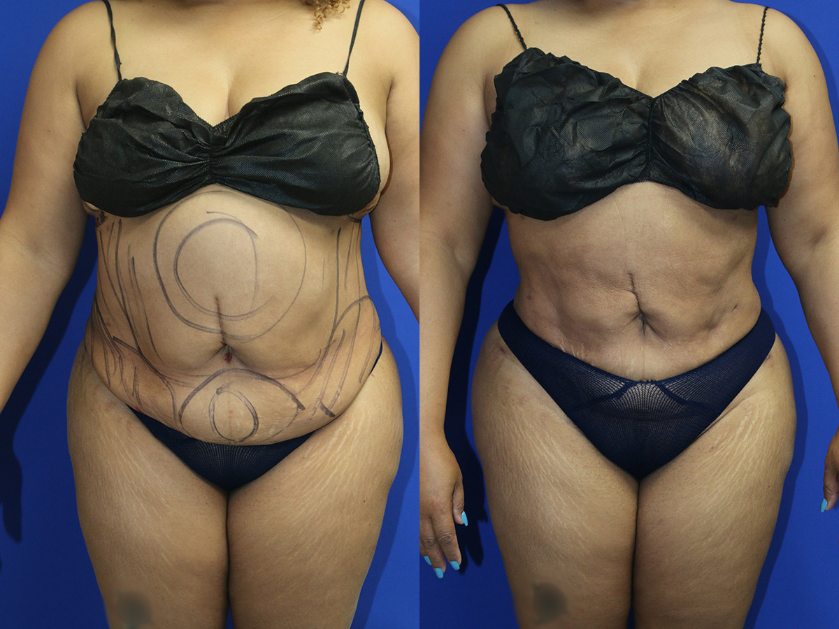 Liposuction/BBL Before and After Photo by Dr. Williams in Memphis Tennessee