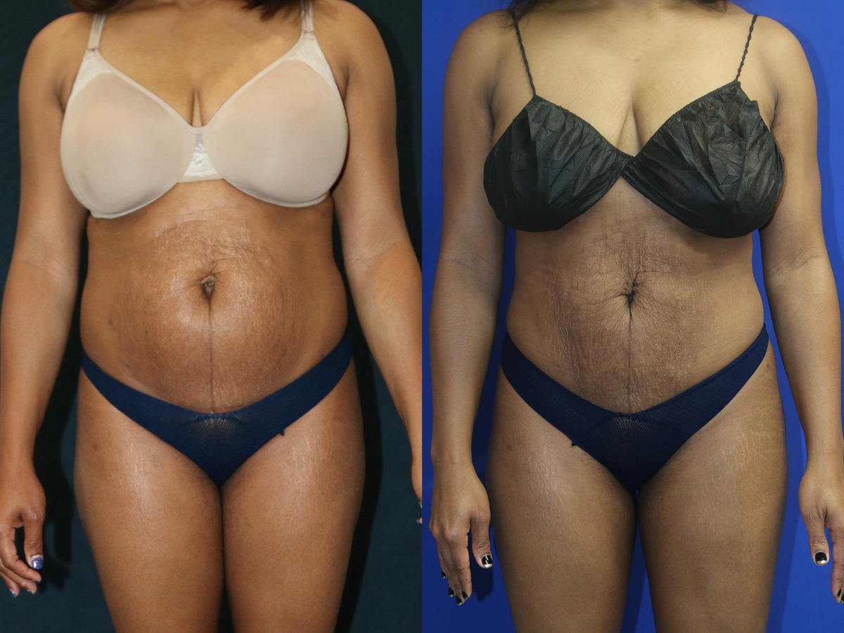 Liposuction/BBL Before and After Photo by Dr. Williams in Memphis Tennessee