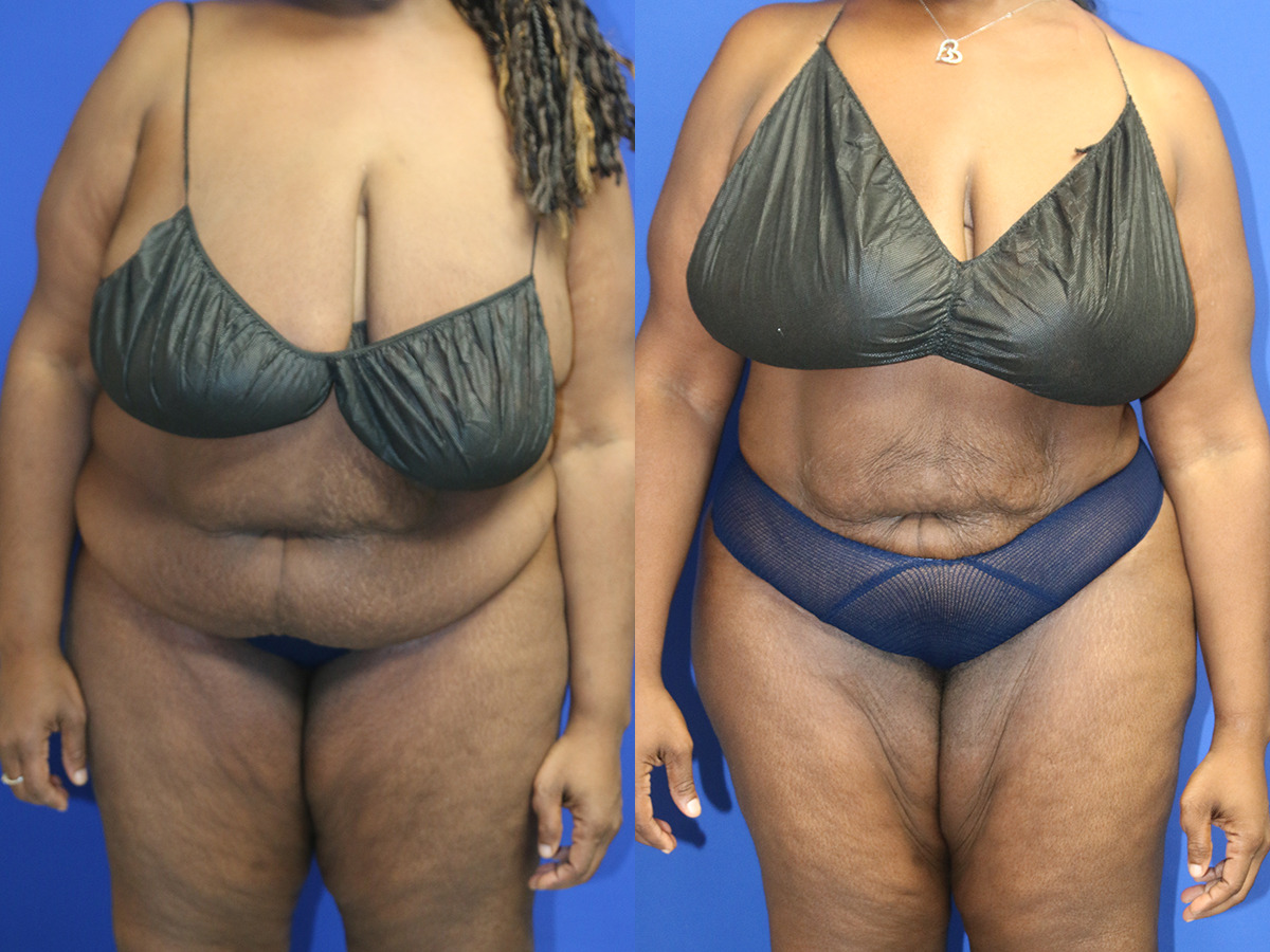 Liposuction/BBL Before and After Photo by Dr. Williams in Memphis Tennessee