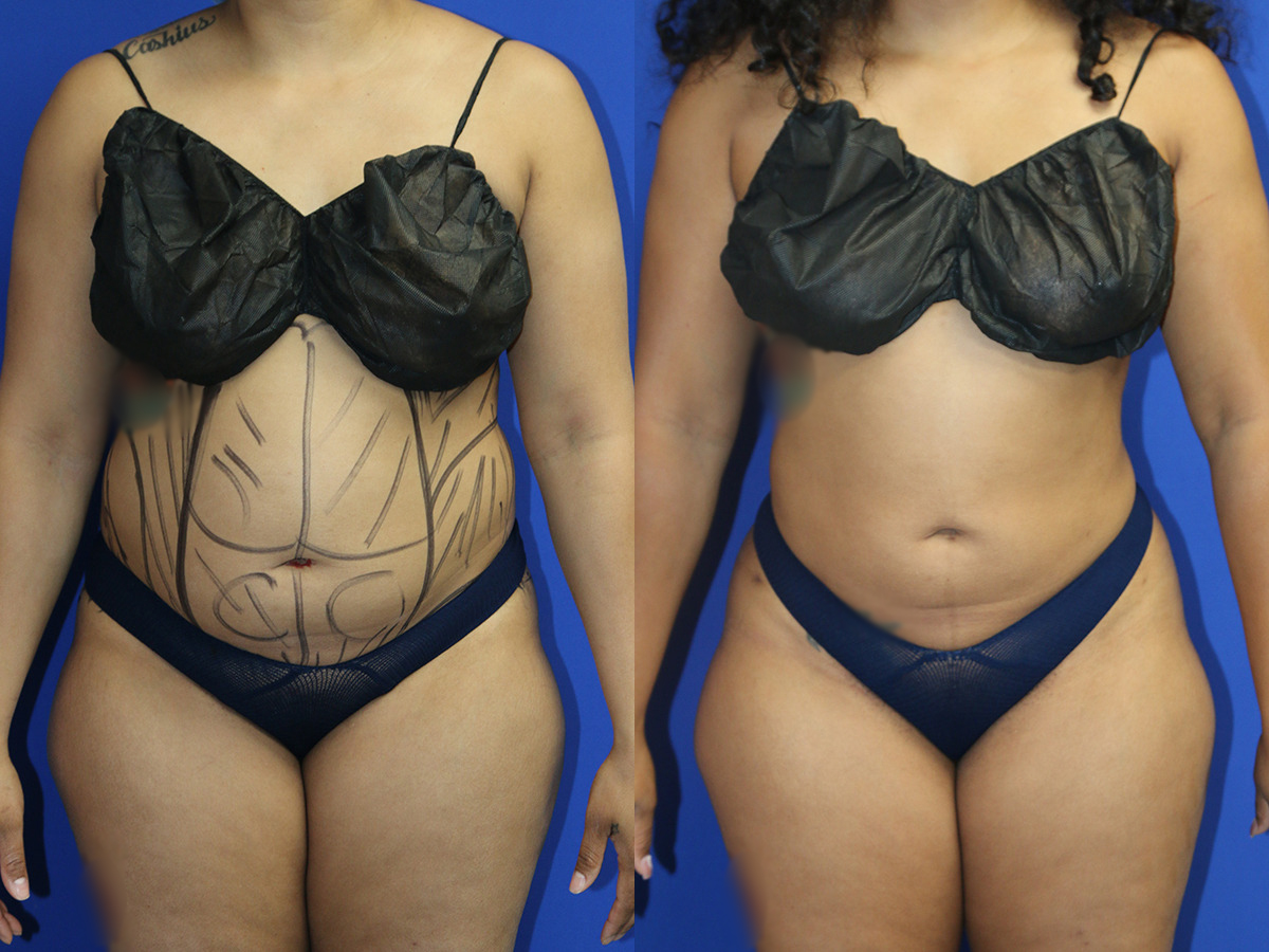 Liposuction 360 Before and After Photo by Dr. Williams in Memphis Tennessee