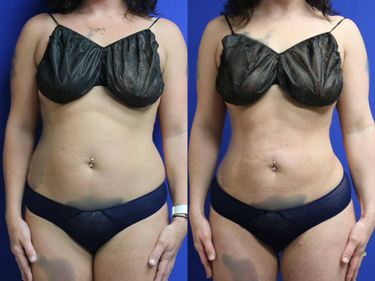 Liposuction/BBL Before and After Photo by Dr. Williams in Memphis Tennessee
