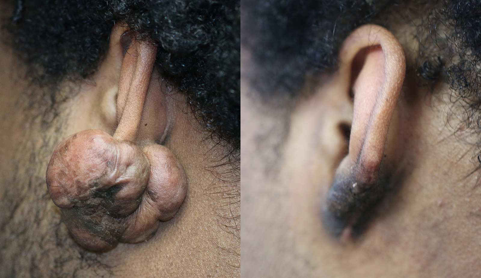Keloid Removal Before and After Photo by Dr. Williams in Memphis Tennessee