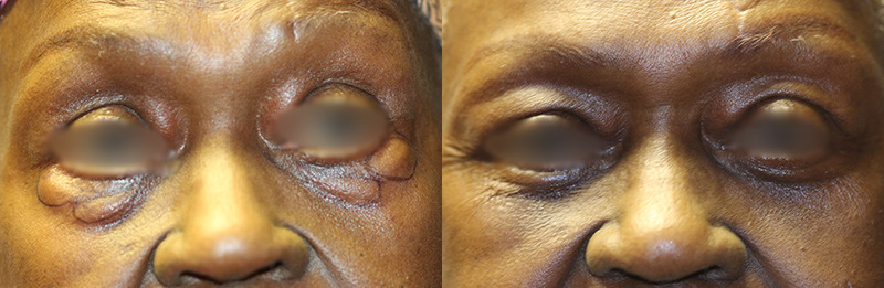 Blepharoplasty Before and After Photo by Dr. Williams in Memphis Tennessee