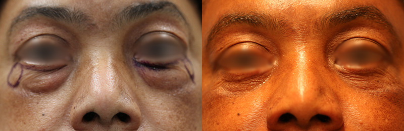 Blepharoplasty Before and After Photo by Dr. Williams in Memphis Tennessee