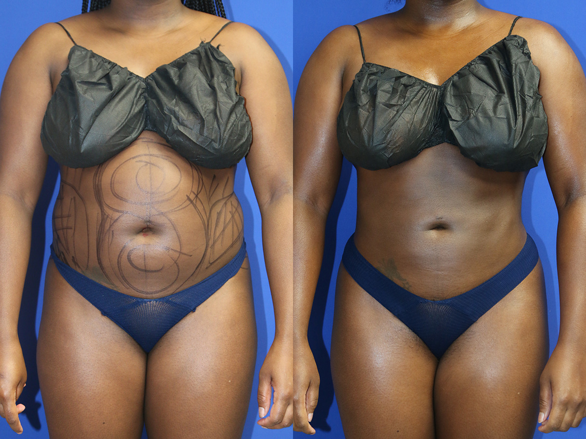 Liposuction Before and After Photo by Dr. Williams in Memphis Tennessee