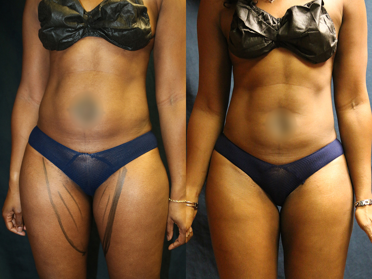 Liposuction Before and After Photo by Dr. Williams in Memphis Tennessee