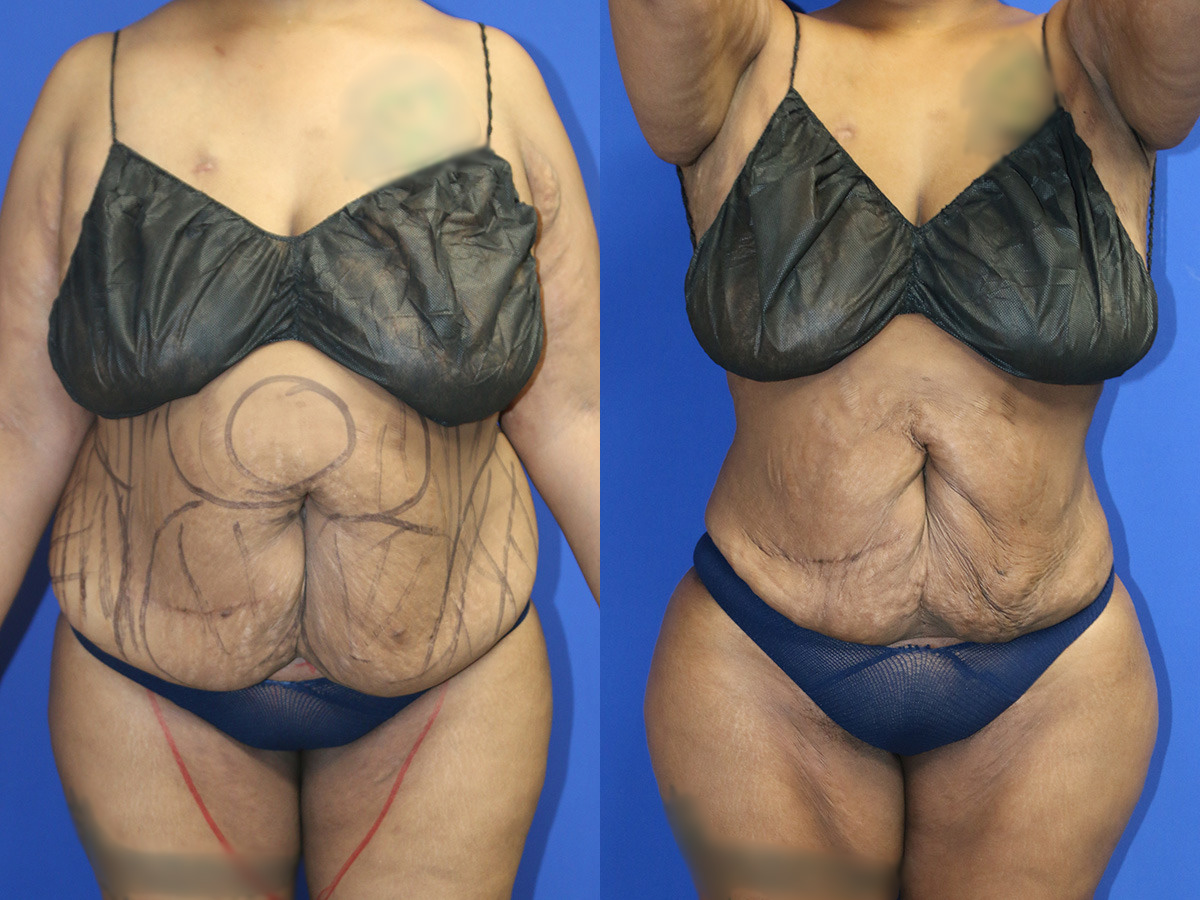 Liposuction/BBL Before and After Photo by Dr. Williams in Memphis Tennessee