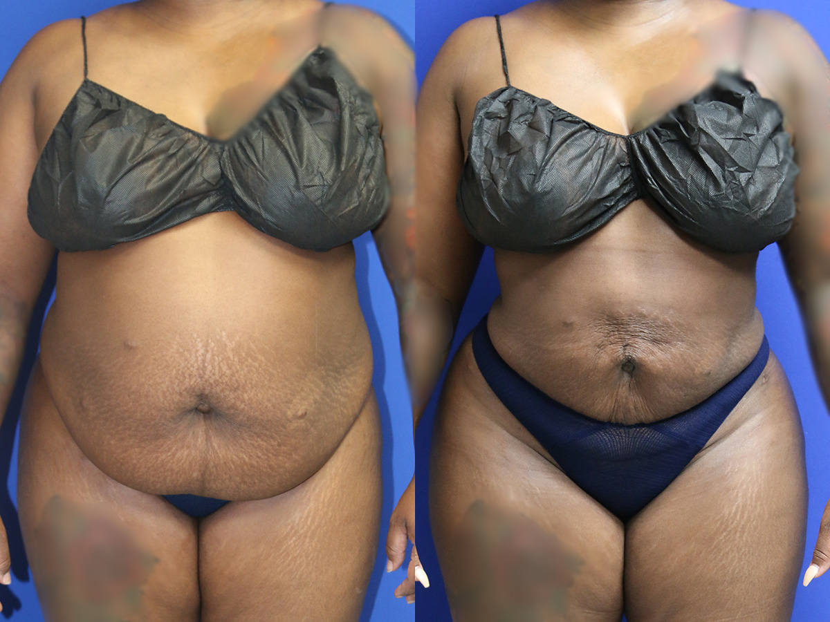 Liposuction/BBL Before and After Photo by Dr. Williams in Memphis Tennessee