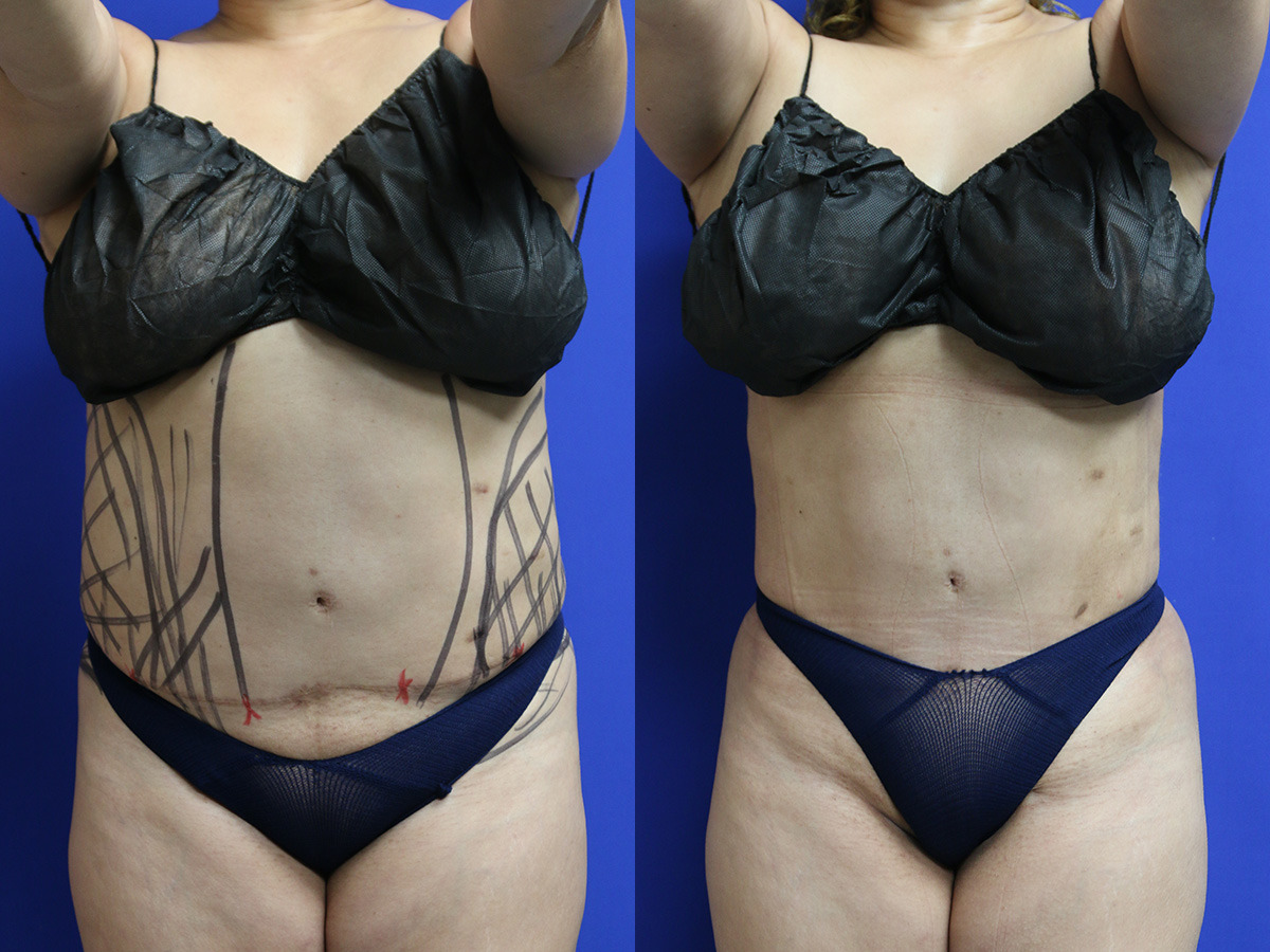 Liposuction360 Before and After Photo by Dr. Williams in Memphis Tennessee