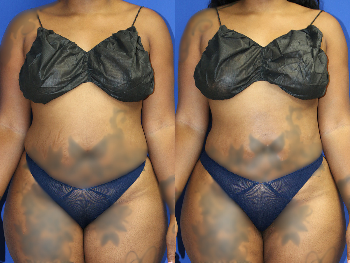 Liposuction/BBL Before and After Photo by Dr. Williams in Memphis Tennessee