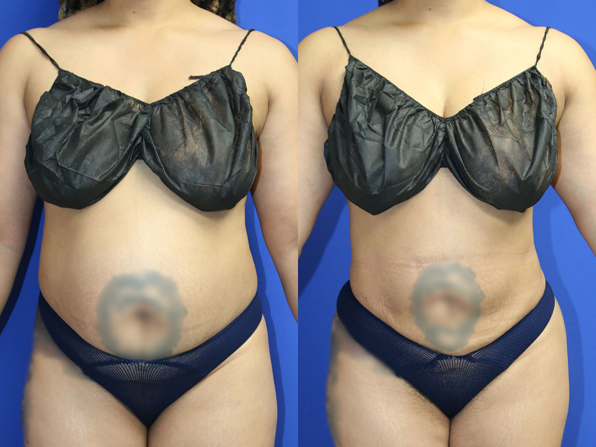 Liposuction/BBL Before and After Photo by Dr. Williams in Memphis Tennessee