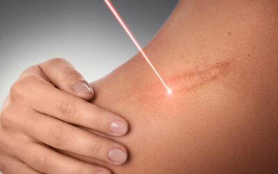 Non-Surgical Keloid Treatment Options: Are They Effective?