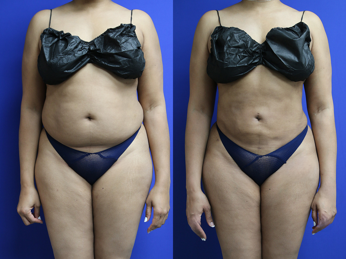 Lipo/BBL Before and After Photo by Dr. Williams in Memphis Tennessee