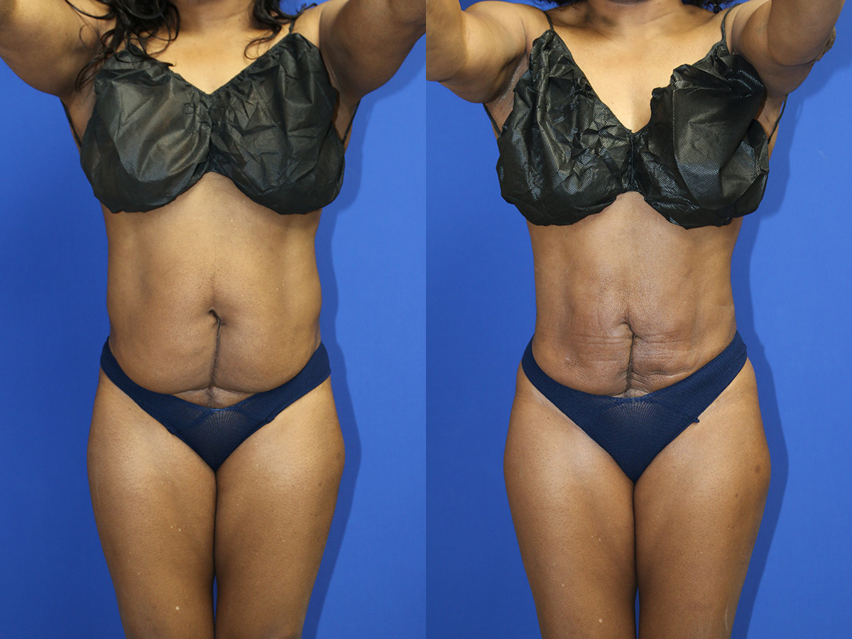 Lipo/BBL Before and After Photo by Dr. Williams in Memphis Tennessee