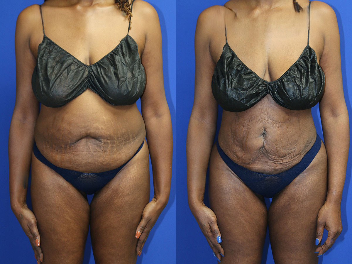 Liposuction Before and After Photo by Dr. Williams in Memphis Tennessee