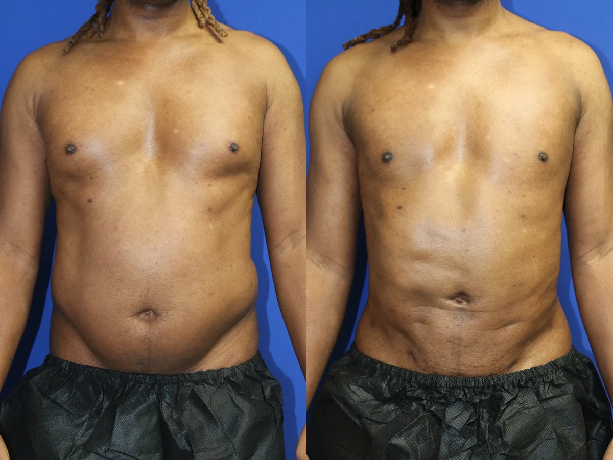 Liposuction Before and After Photo by Dr. Williams in Memphis Tennessee Liposuction Before and After Photo by Dr. Williams in Memphis Tennessee