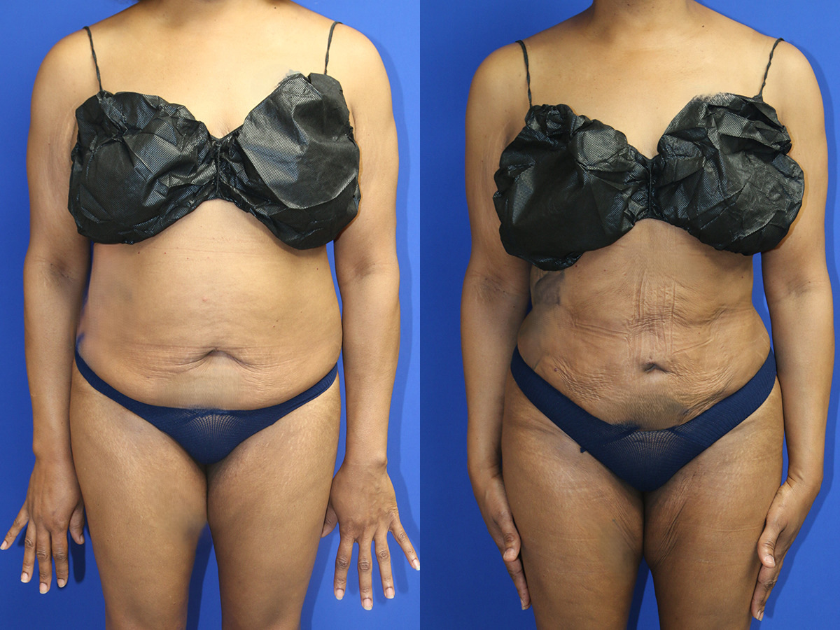 Liposuction/BBL Before and After Photo by Dr. Williams in Memphis Tennessee