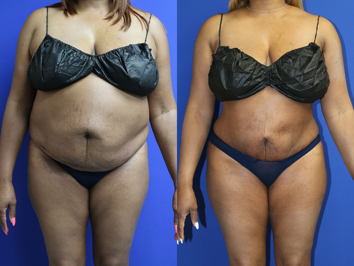 Panniculectomy Before and After Photo by Dr. Williams in Memphis Tennessee Panniculectomy Before and After Photo by Dr. Williams in Memphis Tennessee