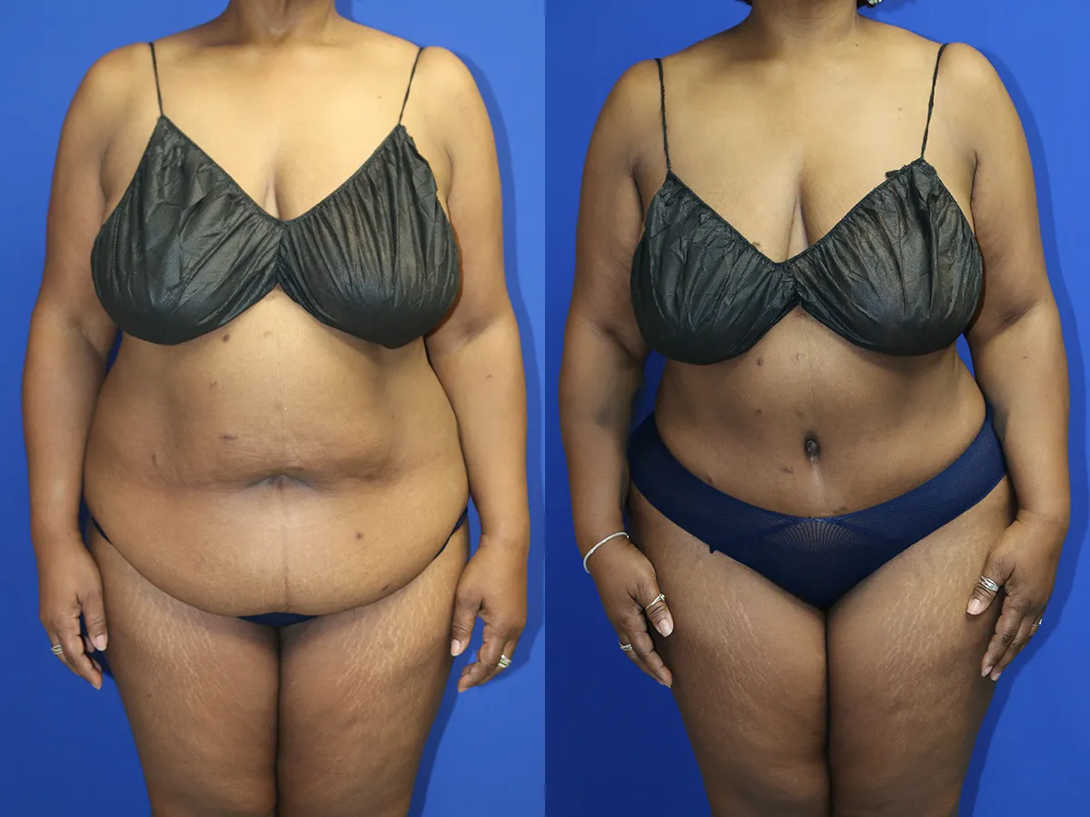 Abdominoplasty Before and After Photo by Dr. Williams in Memphis Tennessee