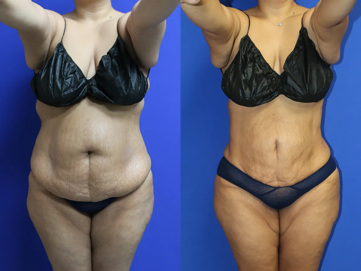Lipo/BBL Before and After Photo by Dr. Williams in Memphis Tennessee