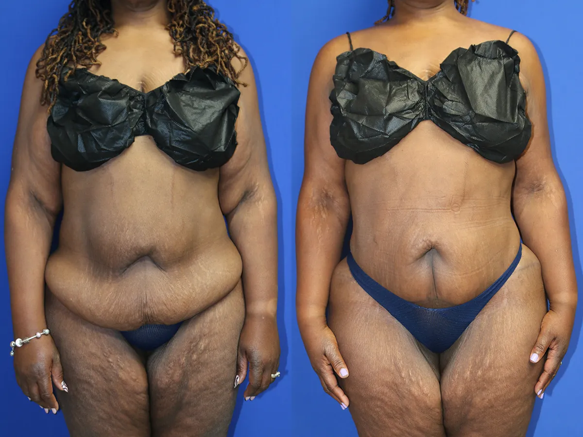Tummy Tuck Before and After Photo by Dr. Williams in Memphis Tennessee