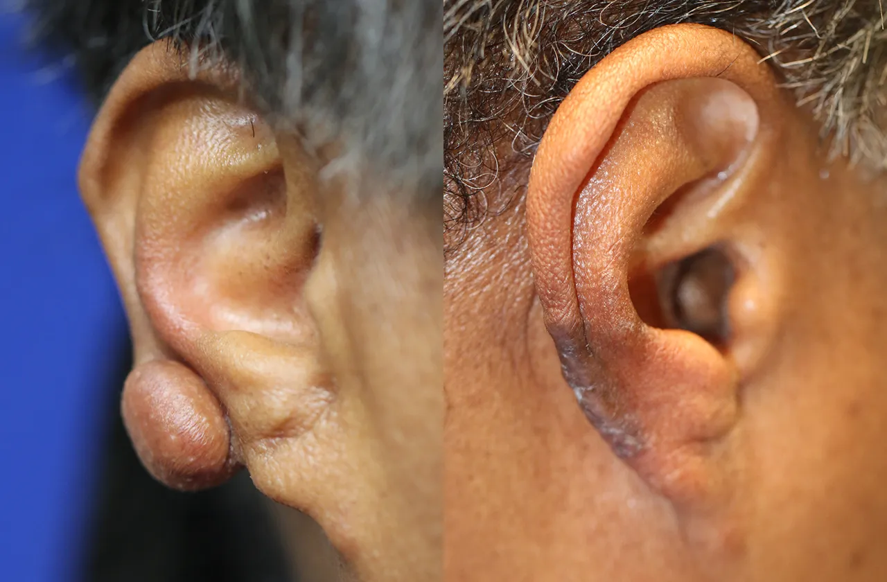Keloid Removal Before and After Photo by Dr. Williams in Memphis Tennessee